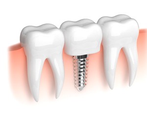 Dental implant graphic