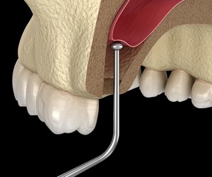 Sinus lift graphic