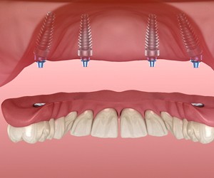 All-on-4 implants