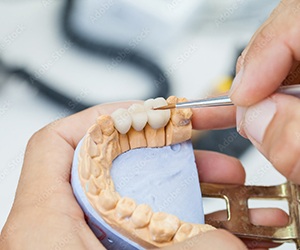 closeup of dental bridge in Portland
