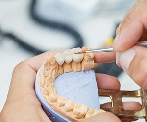 closeup of dental bridge in Portland