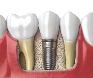 A single tooth implant