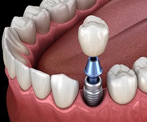 dental implant