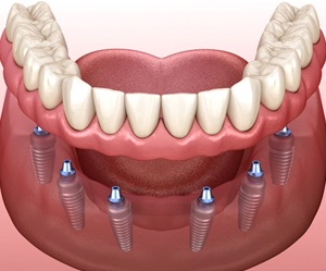 A diagram of an implant-retained denture.