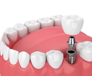 3D model of dental implant