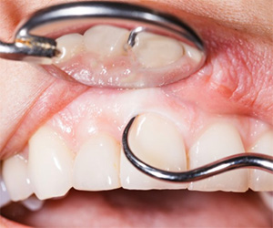 A person receiving periodontal therapy.