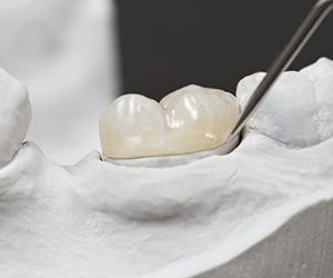 Portland Restorative Dentistry model tooth with dental crown