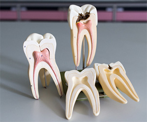 model if decayed teeth