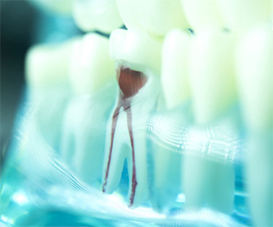model of a root canal
