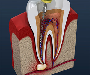 root canal procedure