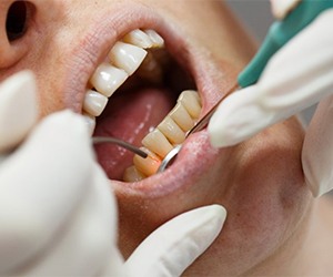 person receiving laser dentistry
