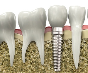 Model of a single tooth dental implant.
