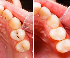 tooth-colored fillings before after