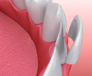 A diagram of porcelain veneers