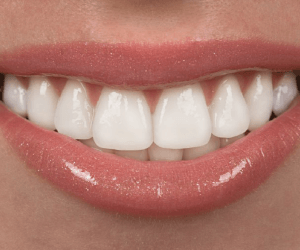 A closeup of a white smile