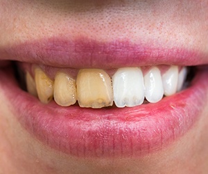 Before and after teeth whitening