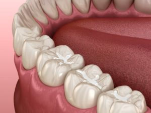 molar fissure dental fillings illustration 