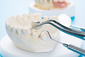 Dental tool holding crown over tooth in a mold of a mouth. 